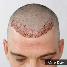 Read more about the article Why hair transplant surgery is so expensive