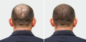 Read more about the article From Balding to Bold: Success Stories of Hair Transplant in Abu Dhabi