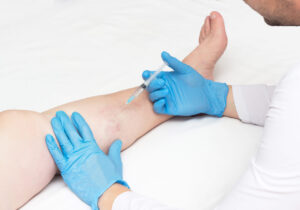 Read more about the article What Do Vein Centers Do: Exploring Varicose Vein Treatment Costs And Benefits