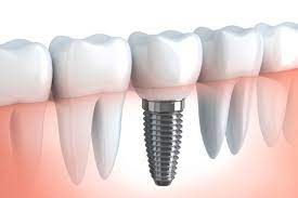Read more about the article What are the Key Benefits of Dental Implants in Houston?