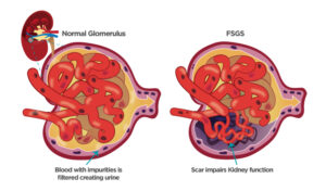 Read more about the article Focal Segmental Glomerulosclerosis (FSGS) Treatment Market Size, Share, Trends, Analysis, Report | CAGR of 8.3% Growth | Forecast 2024-2032